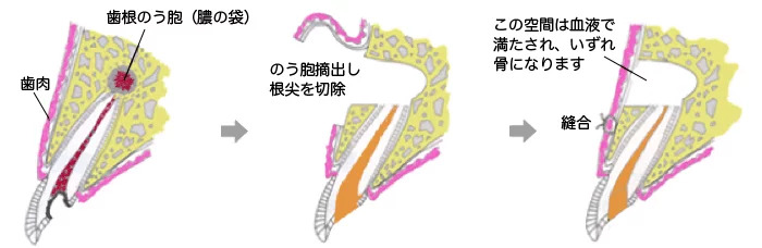 歯根端切除術概念図