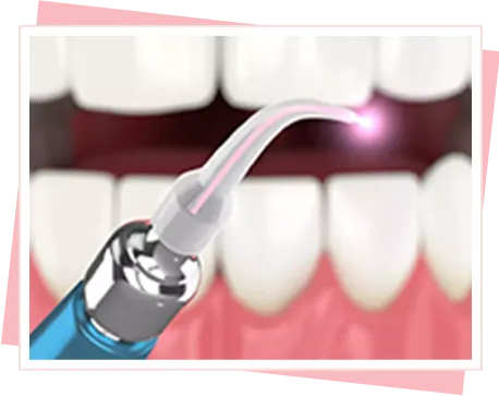 歯周病/歯槽膿漏